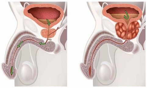 prostatitis osasuntsua eta hanturazkoa