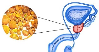 mota prostatitis