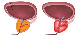 prostatitis gizon