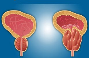 prostatitis argazkiak