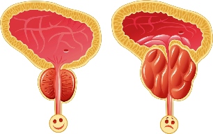 Normala prostatako eta inflamed