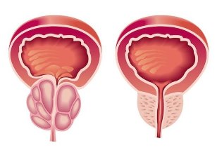 Nola ez, prostatitis