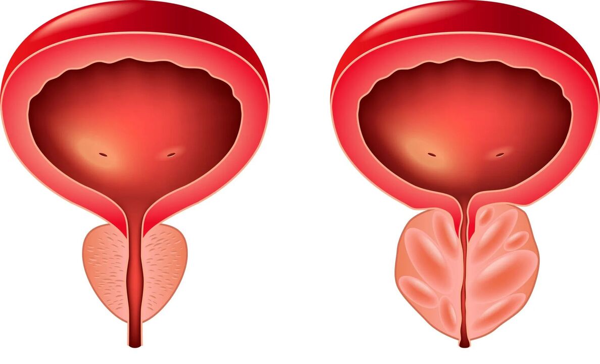 prostata normala eta gaixoa